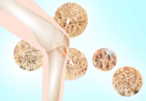 Osteoporóza – alternatívne spôsoby liečby