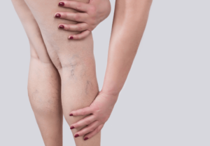 Cievne ochorenia: príčiny, rizikové faktory, alternatívne spôsoby liečby